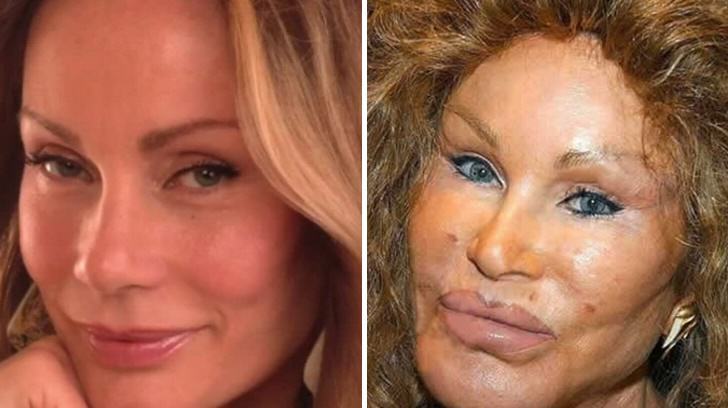 16 híresség aki brutálisan tönkretette magát a plasztikai beavatkozásokkal